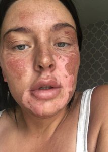 TikTok Egg Hack Leaves Woman With Serious Burns TikTok Death